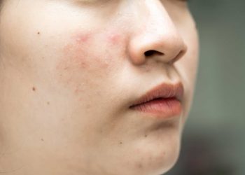 Kalau Jerawat dan Bekasnya Datang Bergantian, Apakah Rutinitas Skincare Harus Ikut Dibedakan?