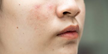 Kalau Jerawat dan Bekasnya Datang Bergantian, Apakah Rutinitas Skincare Harus Ikut Dibedakan?