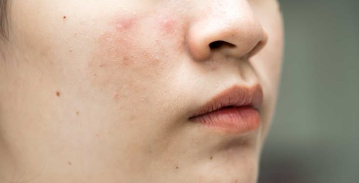 Kalau Jerawat dan Bekasnya Datang Bergantian, Apakah Rutinitas Skincare Harus Ikut Dibedakan?