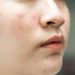 Kalau Jerawat dan Bekasnya Datang Bergantian, Apakah Rutinitas Skincare Harus Ikut Dibedakan?