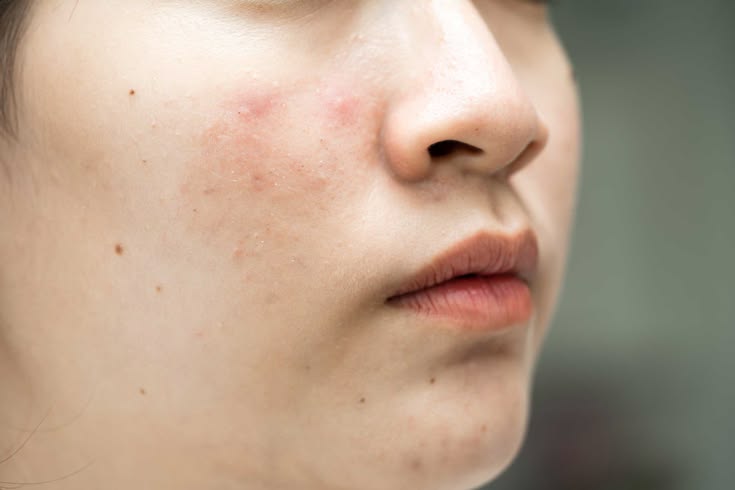 Kalau Jerawat dan Bekasnya Datang Bergantian, Apakah Rutinitas Skincare Harus Ikut Dibedakan?